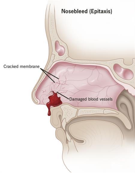 Nosebleeds – Dr. Adam Stewart