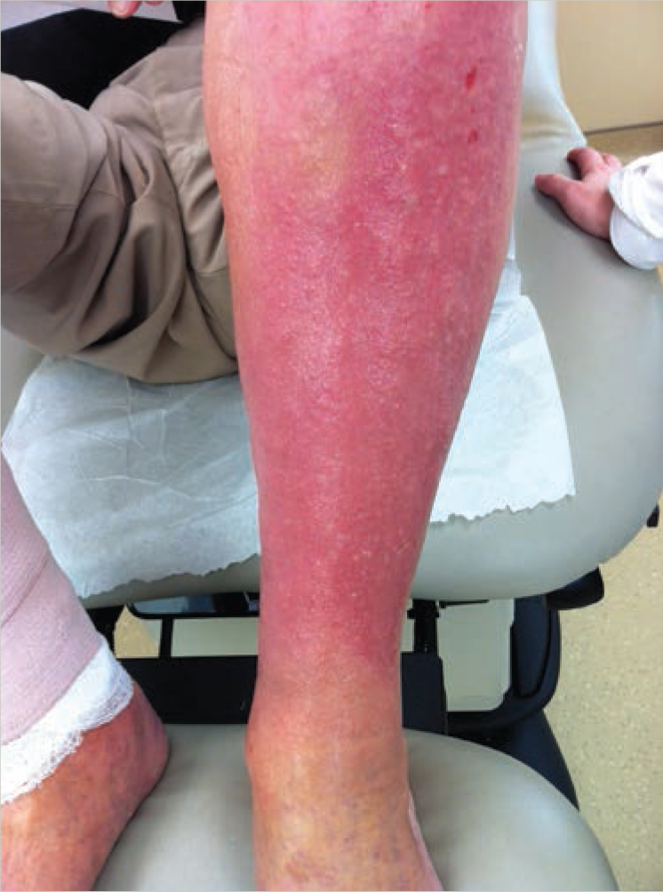 Venous Insufficiency, Venous Stasis