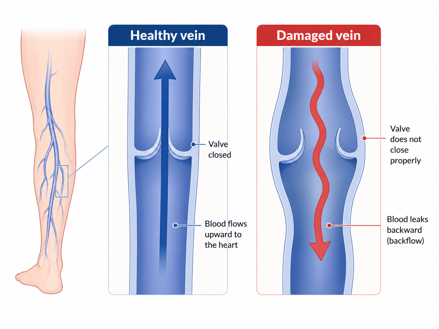 Calf Vein Valve