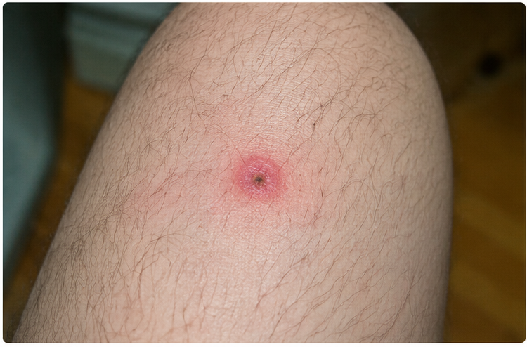 Tick Bite Mark 1