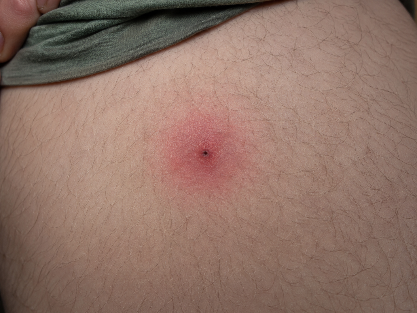 Tick Bite Red