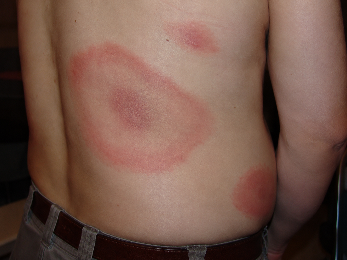 Tick EM Rash