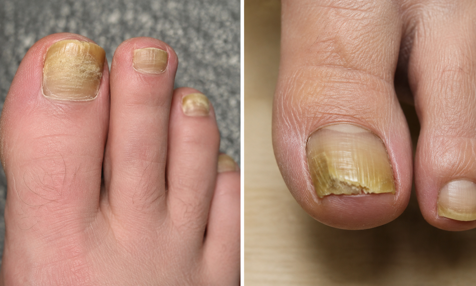 Toenail Fungus